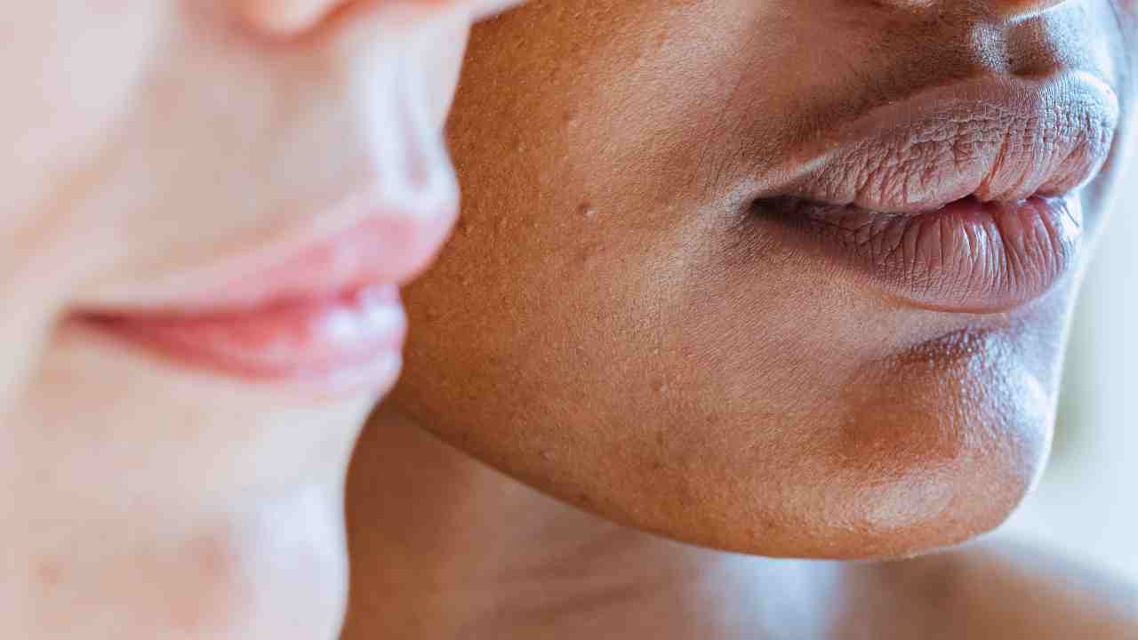 Melanoma Risk Factors What to Be Aware Of