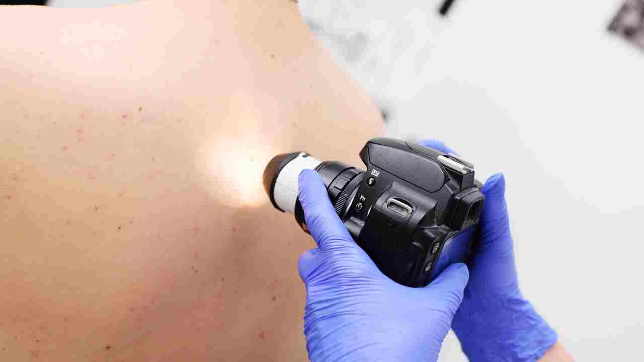 Sun Exposure and Melanoma The Link is Clear