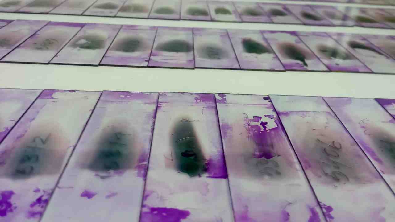 alzheimers biopsy