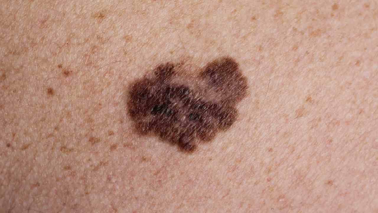 axillary melanoma
